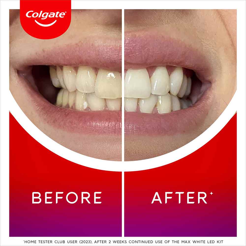 Colgate Max White LED Teeth Whitening Kit - Image 3