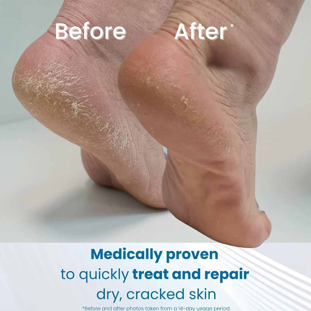 Flexitol Cracked Heel Balm 25% Urea With Vitamin B5 + Shea Butter 112g - Image 5
