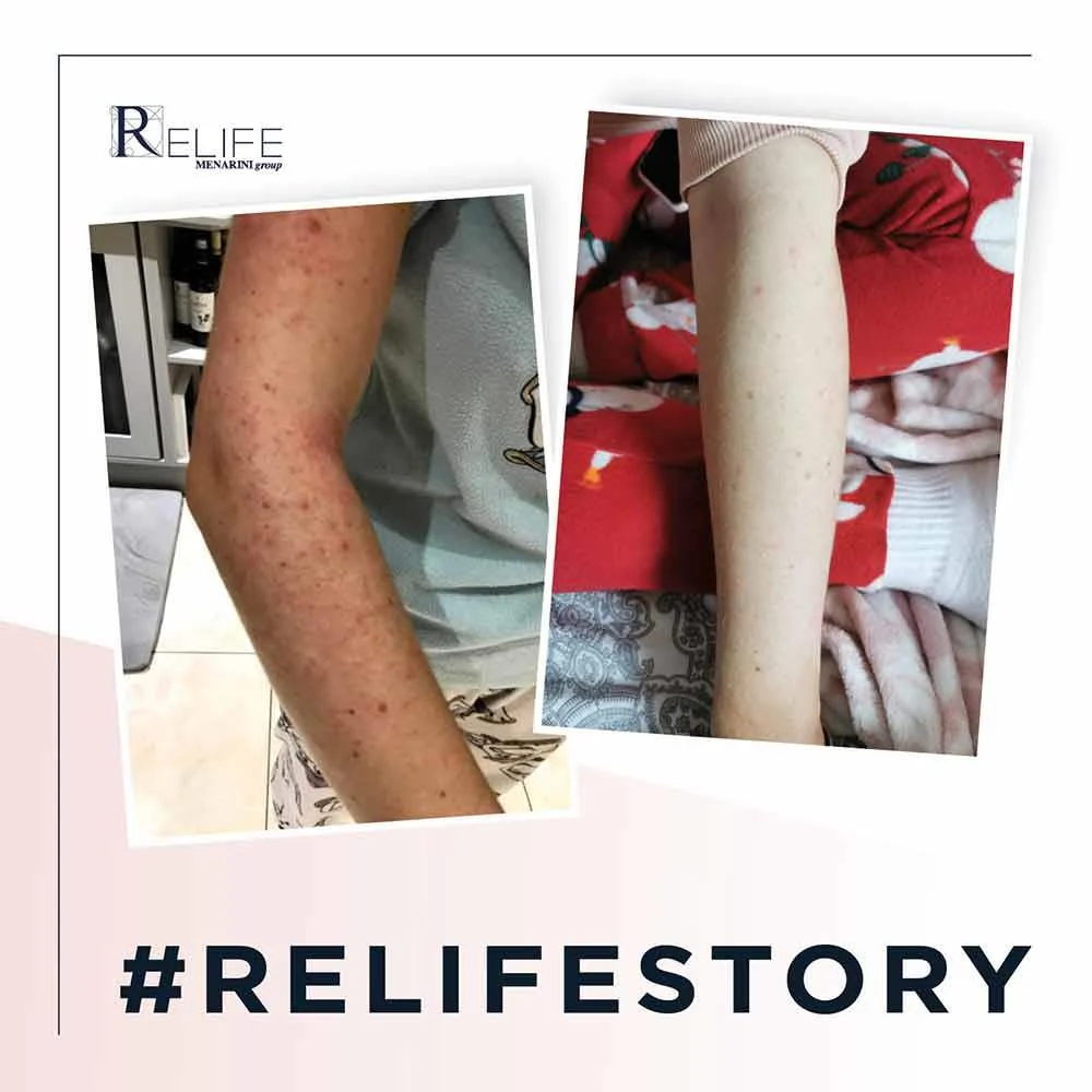 Relife Relizema Cream 100ml - Image 3