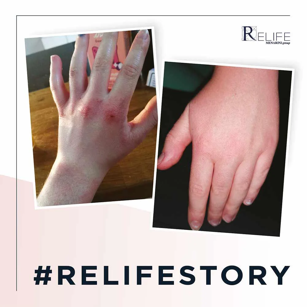Relife Relizema Cream 40ml - Image 3