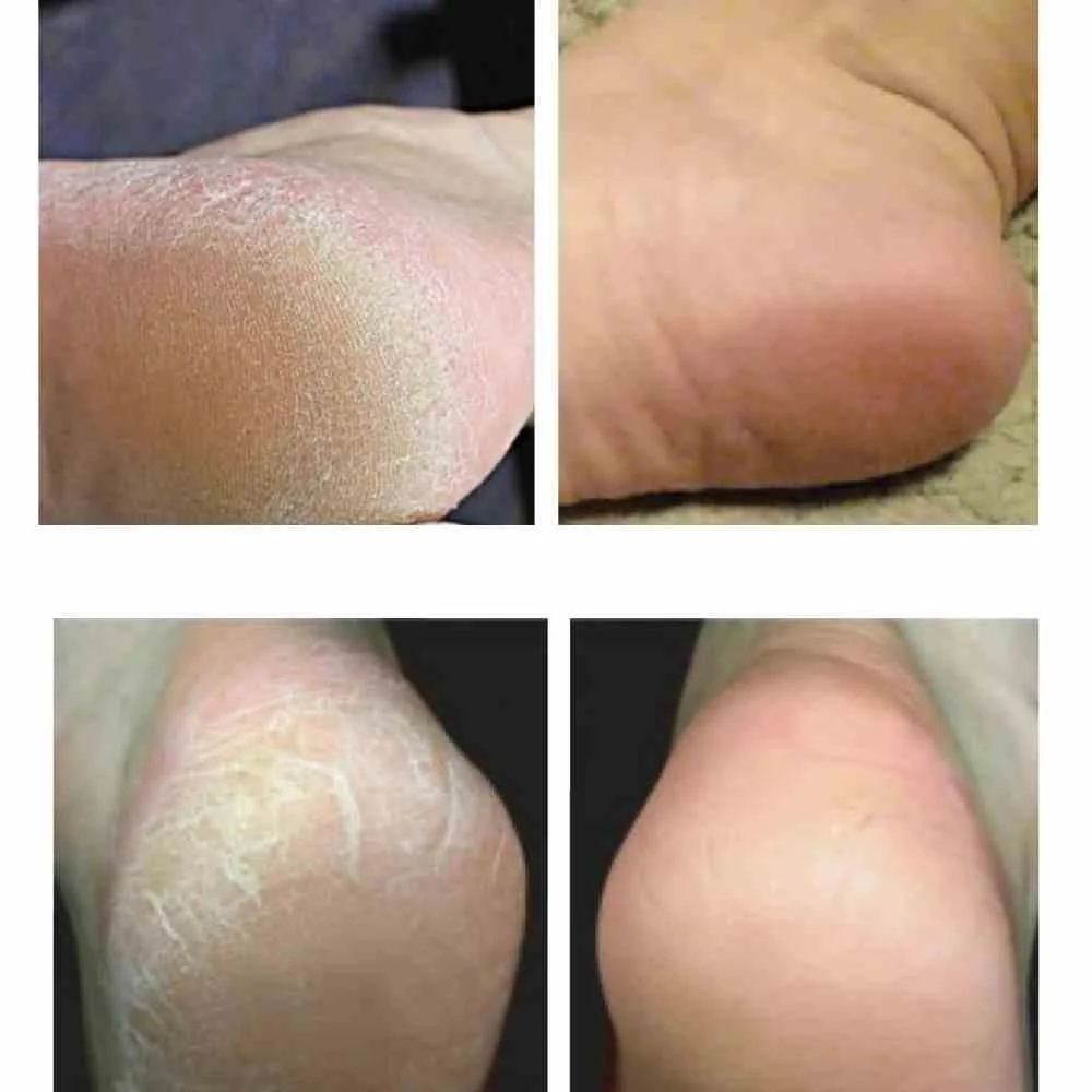 Softsole Exfoliating Foot Peel 50ml - Image 6