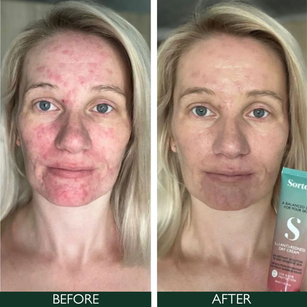 Sorted Skin 5 In 1 Anti-Redness Day Cream SPF50 30ml - Image 6